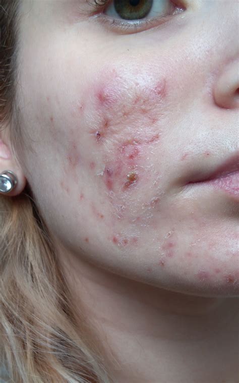Roaccutane 30mgfor 6 Months Pictures Included Accutane