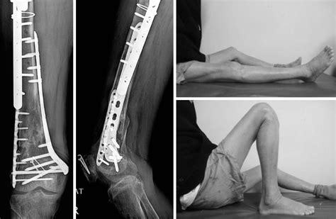 Medial Plating Of Distal Femoral Fracture With Locking Compression