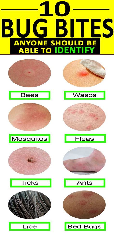 10 Bug Bites Anyone Should Be Able To Identify Bug Bites Remedies