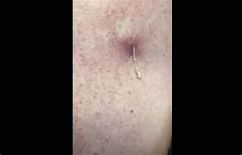 Cyst On The Back Popped At Home New Pimple Popping Videos