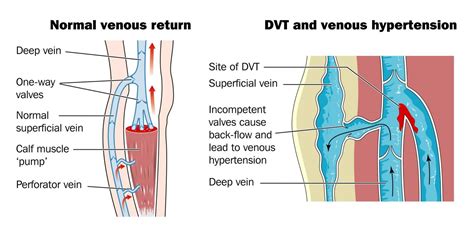 They dissolve after your injury heals. Deep Vein Thrombosis Singapore | Causes Symptoms Diagnosis