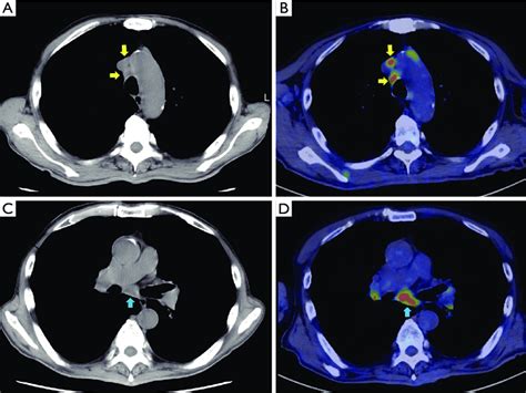 Preoperative Ct And 18 F Fdg Pet Ab Mediastinal Lymph Node Swelling