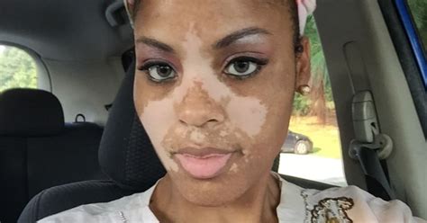 Mum With Vitiligo Embraces Rare Skin Condition Im Still A Normal Woman