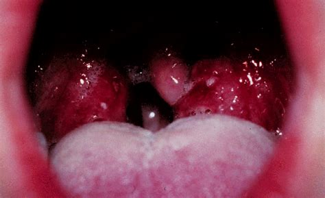 Eine mandelentzündung (tonsillitis oder angina tonsillares) ist eine schmerzhafte entzündung der gaumenmandeln und wird durch bakterien oder viren ausgelöst. Tonsillitits