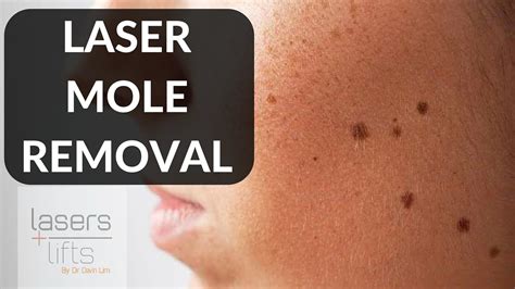 Laser Mole Removal Youtube