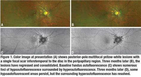 Flashing Blind Spots And Retinal Dots