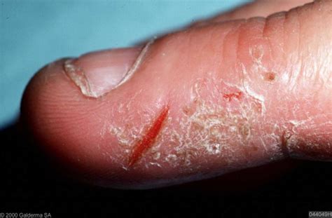 Hand Eczema Hand Dermatitis Free Download Nude Photo Gallery