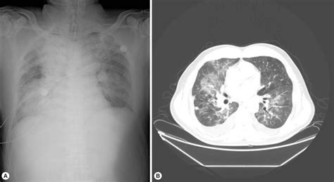 A Chest Radiograph A And A Contrast Enhanced Chest Ct Scan B Taken