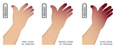 Hand Of Man With Different Stages Of Frostbite Freezing And Skin