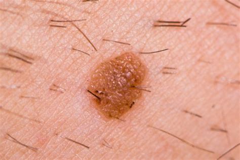 Is A Fast Growing New Mole Always A Melanoma Scary Symptoms
