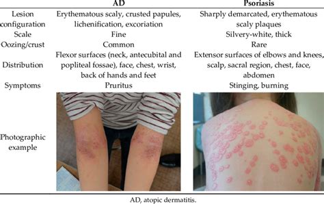 Atopic Dermatitis Ad Gm Rkb
