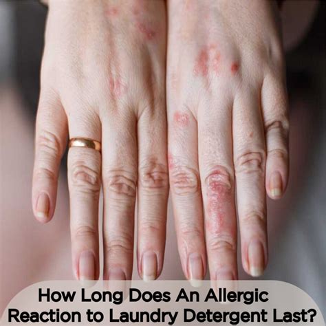How Long Does An Allergic Reaction To Laundry Detergent Last