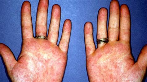 What Causes Arthritis In The Hands