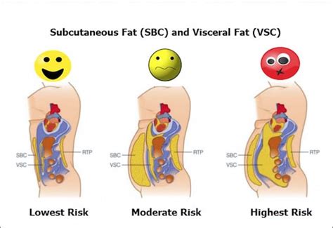But visceral fat—fat inside the abdomen—is little more than a time bomb wrapped around a belly.visceral obesity results in fatty acids accumulation in fluoride is added to the water to reduce tooth decay, reducing cavities by up to 1/3 of previous rate. Visceral Fat and Subcutaneous Fat: What's the Difference ...