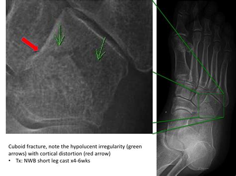 Foot fractures