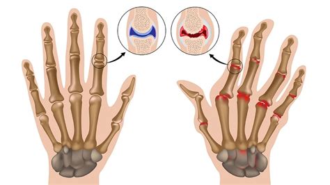 Hand Und Fingerarthrose Ursachen Arthrose