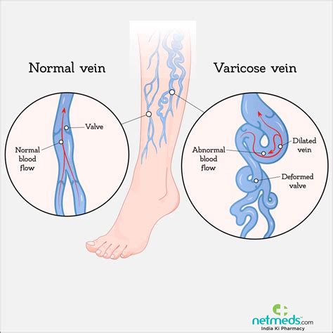 Varicose Veins Causes Symptoms And Treatment Netmeds