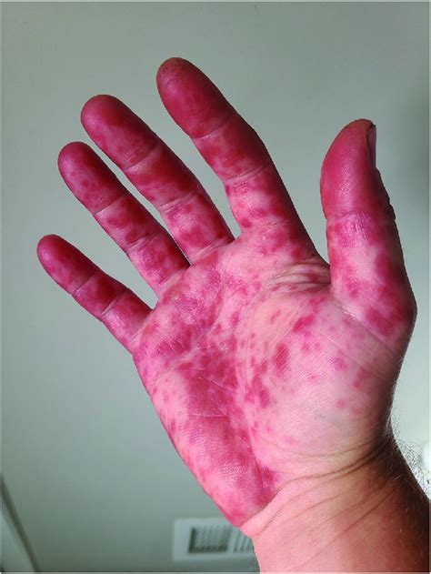 Maculopapular Rash On The Palm Of Hfmd Patient Image Credit Reddit