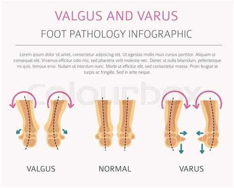 Foot Deformation As Medical Desease Stock Vector Colourbox