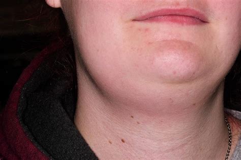 Swollen Lymph Glands In Neck Photograph By Dr P Marazziscience Photo