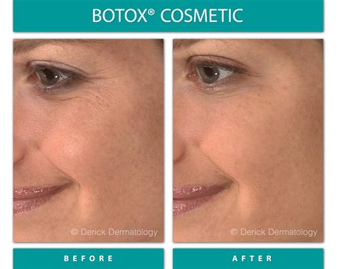 Before And After Gallery Botox Derick Dermatology