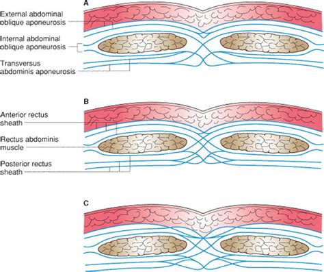 Abdominal Wall Hernias Basicmedical Key