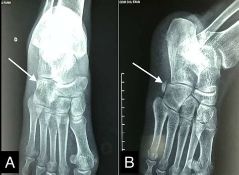 X Ray Of The Right Foot A Front View B Profile View Showing The
