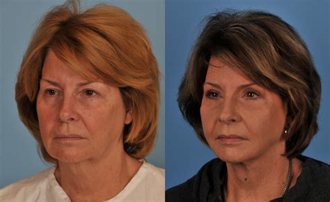 facelift neck lift before and after pictures case 98 toronto on ford plastic surgery dr
