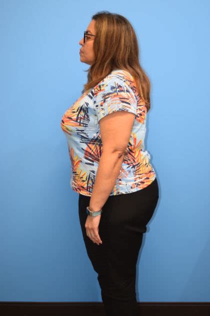 Patient 528 Gastric Sleeve Before And After Photos Houston Plastic