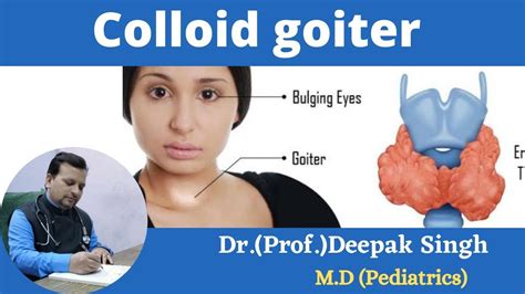 Colloid Goiter Iodine Deficiency Goiter Deepak Pd Singh Youtube