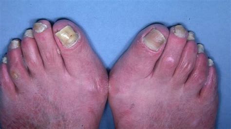 Toenail Discoloration Causes Related Symptoms Treatments
