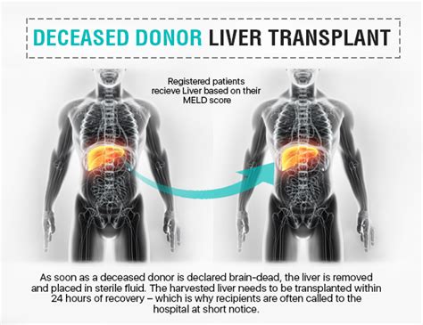 What Is Ddltdeceased Donor Liver Transplant Score Ailbs