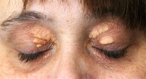 Pin On How To Remove The Cholesterol Deposits Around Your Eyes Healslife