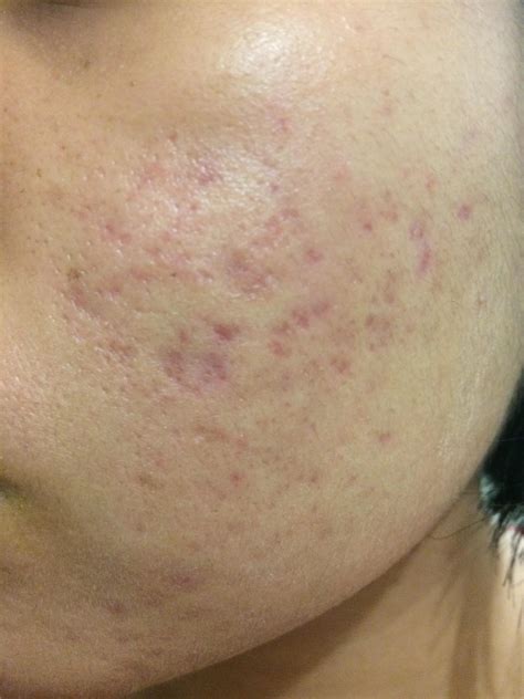 Advice On What To Do With These Acne Scars Scar Treatments