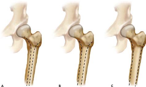 Metaphyseal Engaging Femoral Components Musculoskeletal Key