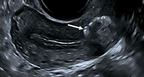 2d Sagittal Ultrasound Of Uterus With Iub Arrow In Lower Uterine