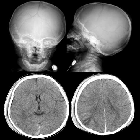 Pediatric Skull Fracture Pediatric Radiology Reference Article