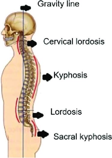 Schematic Representation Of The Kyphosis And Lordosis Pathologies
