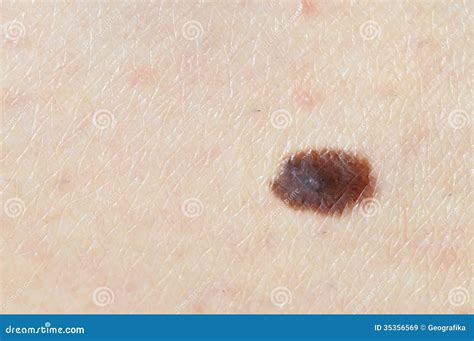 Brown Birthmark Nevus On Caucasian Woman Leg Stock Image Image Of