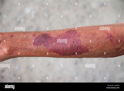 Arm With Blood Outpouring Stock Photo Alamy