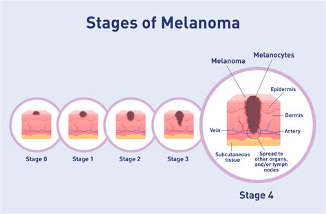 Stage 4 Melanoma