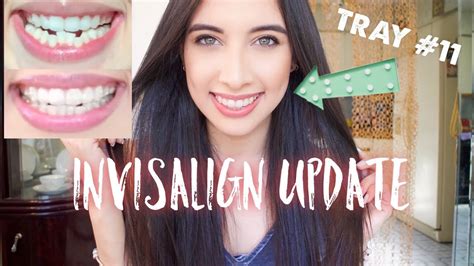 Invisalign Update Tips Beforeafter Pics More Youtube
