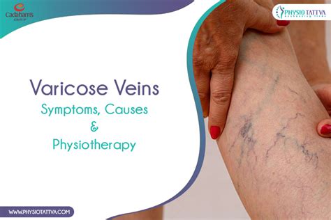 Symptoms Causes And Physiotherapy For Varicose Veins