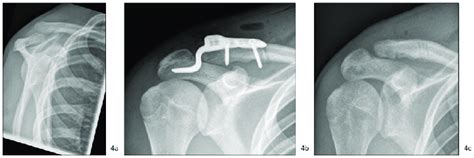 Acromioclavicular Joint Dislocation Treated With Hook Plate