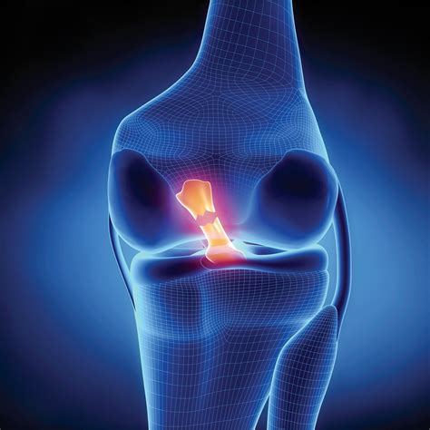 incomplete rehab after acl reconstruction leads to 4 times the risk of recurrent tear arizona