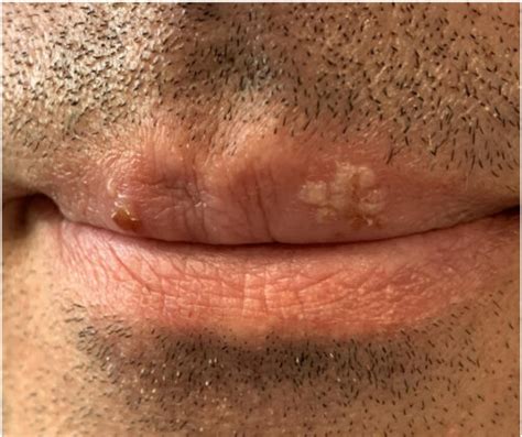 Fordyce Spots On Lips Treatment Healths Digest