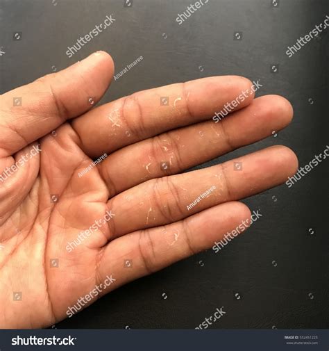 Hand Skin Peeling Due Allergic Reaction Stock Photo 552451225