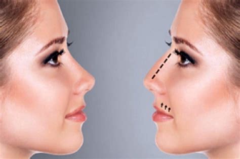 Why Consumers Will Love The Results Of A Nose Thread Lift