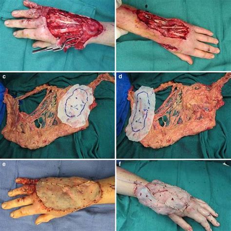Case 5, patient with bilateral hand crush/degloving injury, a, b defect ...