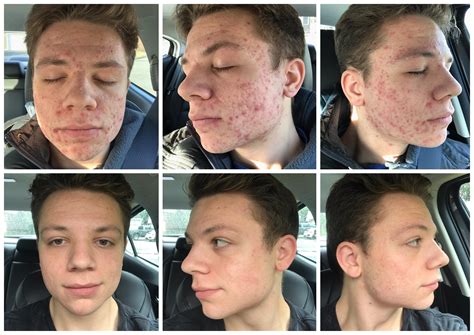 Before And After 4 Months Of Accutane 🙂🙂 Raccutane